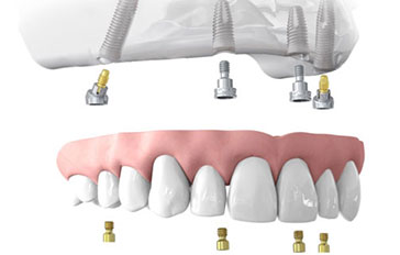 Dental Implants Fixed Dentures