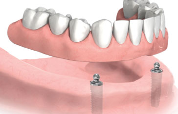 Denture Implants Brooches System