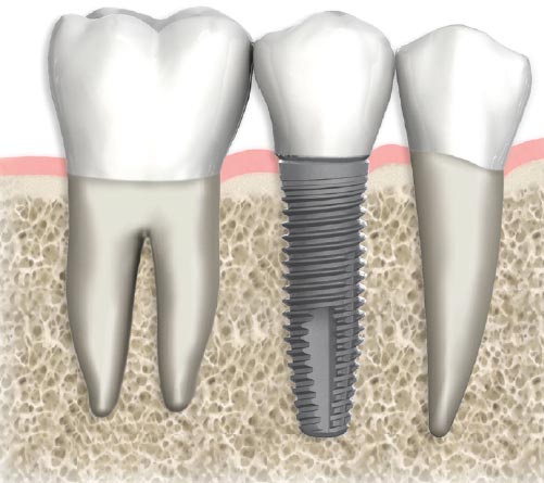 Dental Implants In Miami, FL