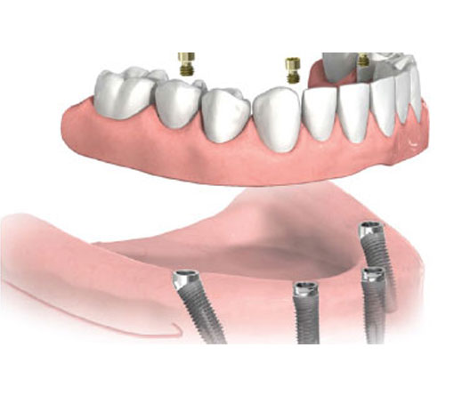 Dental Implants for Fixed Dentures Miami, FL