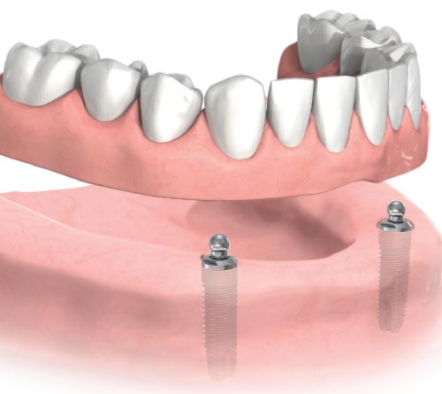 Denture Implants Brooches System Miami, FL
